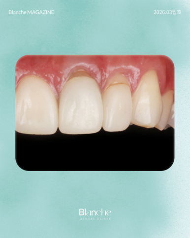 옛날에 한 라미네이트, 요즘 자꾸 신경 쓰인다면? 관련 이미지 3