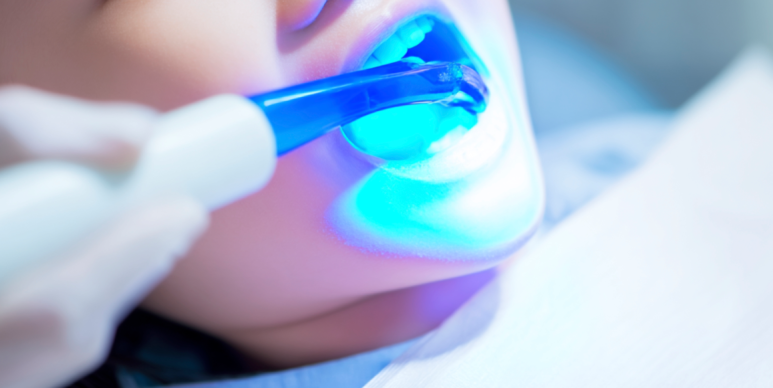 Composite Resin vs. Inlay: Differences in Price, Lifespan & Insurance Coverage | A Dentist’s Guide to Choosing Cavity Treatment image 4