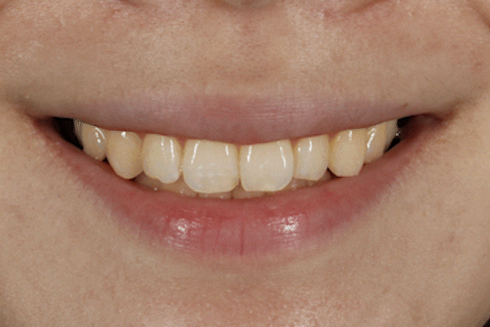 무삭제 라미네이트 추천, 어떤 케이스에 적합할까요? 관련 이미지 1