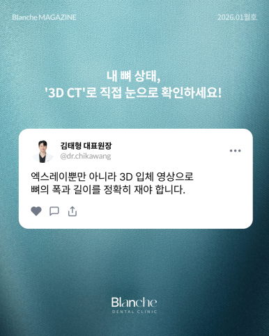"임플란트 뼈이식, 무조건 해야 하나요?" 과잉진료 피하는 법 관련 이미지 8