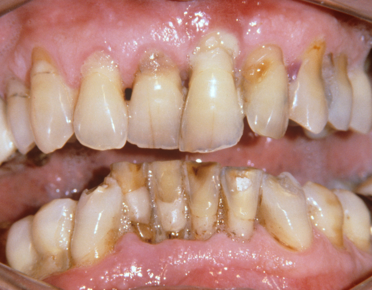 풍치 치료 초기&middot;중기&middot;말기, 단계별 치료비가 10배 차이 나는 이유 관련 이미지 8