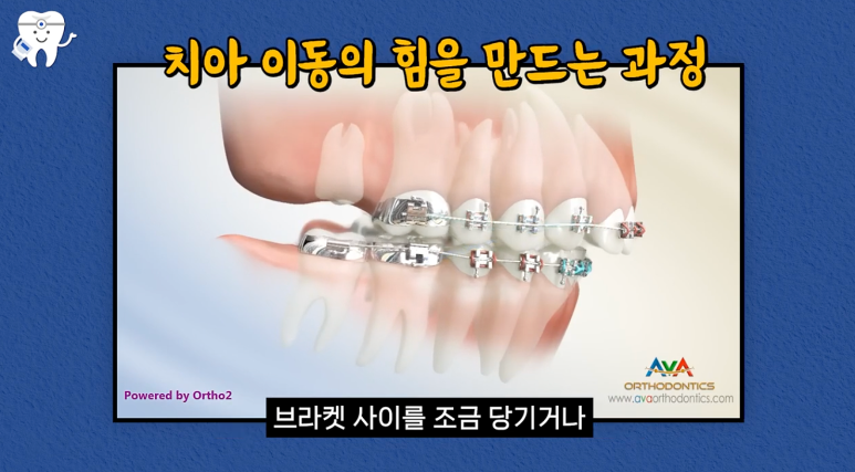 압구정치과 치아교정이 고민이라면 필독 관련 이미지 4