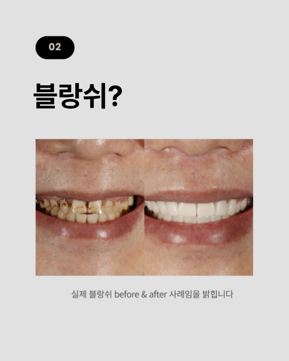 무삭제 라미네이트 vs 블랑쉬, 대표원장이 직접 알려주는 차이점 관련 이미지 6