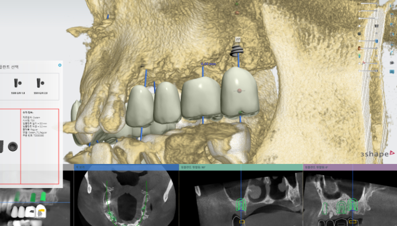 임플란트가 두렵다면 반드시 읽으세요! 관련 이미지 17