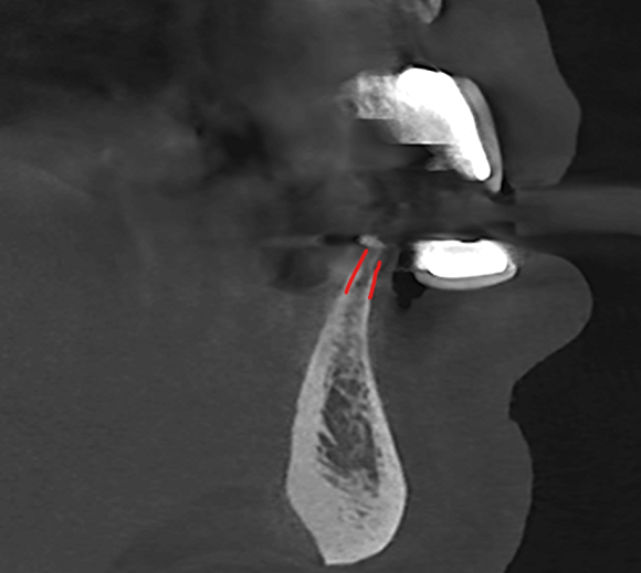 신논현치과 임플란트 뼈이식 강남 치과의사로서 솔직히 말씀드립니다. 관련 이미지 6