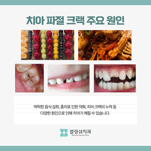 이빨 깨짐 방치하면 발치까지? 크랙치아 치료법과 응급처치 관련 이미지 2