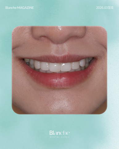 옛날에 한 라미네이트, 요즘 자꾸 신경 쓰인다면? 관련 이미지 11