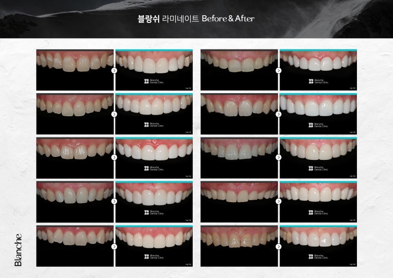 이제 라미네이트 말고 관련 이미지 8
