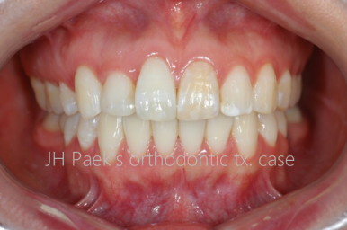 뻐드렁니 교정 2년 고생하고 후회하는 사람 vs 6개월 만에 인생 미소 찾은 사람 관련 이미지 5
