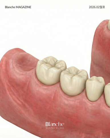 어금니 뺀 자리, 당장 안 아픈데 꼭 임플란트 해야 할까? 관련 이미지 3