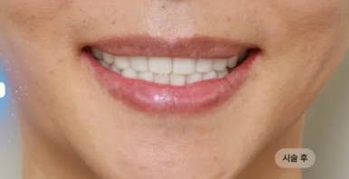 5 Criteria to Review Before Deciding on Minimal-Preparation Veneers image 7
