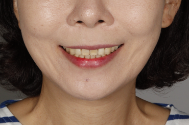 발치 없이 가능할까? 앞니 부분교정 전 반드시 체크해야 할 진단 포인트 관련 이미지 10