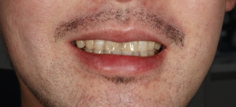 치아미백 시술? 블랑쉬? 어떤 것이 좋을지 고민된다면 관련 이미지 7