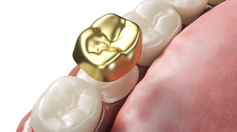 Can a Molar Cavity Be Treated with an Inlay, or Does It Need a Crown? — How Chewing Forces Determine the Choice image 3
