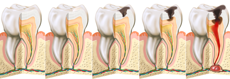 Root Canal Treatment vs. Extraction: When a Dentist Determines That a Natural Tooth Can Be Saved image 3