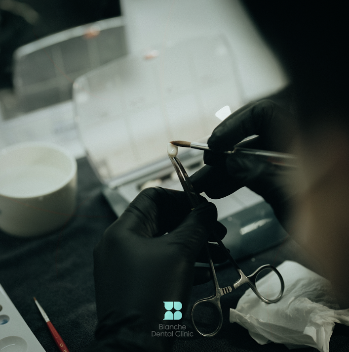 Black Triangles: Causes and Prevention to Know Before Resin Treatment image 7