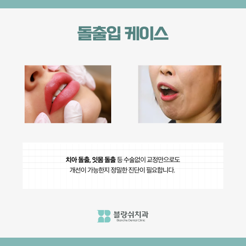 강남 돌출입 교정치과 분납 비용 부담된다면 관련 이미지 1