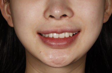 [블랑쉬치과] 치아 교정하고 난 후에 블랑쉬 가능할까요? 관련 이미지 6