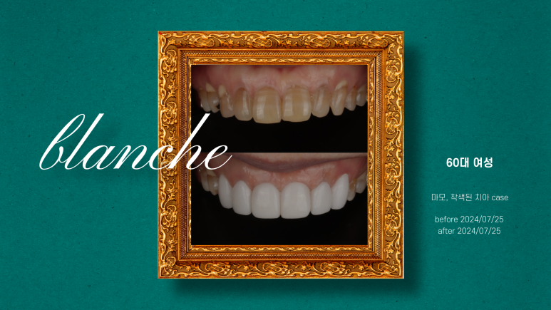 치아 고민별 블랑쉬 적합사례 총정리 관련 이미지 5