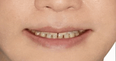 치아미백 시술,  시간과 가격 한계점까지 알려드립니다. 관련 이미지 15