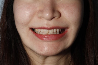 앞니 라미네이트 가격, 자연치아 보존이 우선이라면 관련 이미지 14