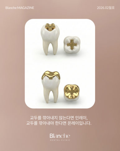 충치 치료, 무조건 깎아서 씌워야 할까? 관련 이미지 7