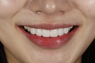 무삭제 라미네이트 부작용, 꼼꼼히 따져봐야할 핵심 관련 이미지 14