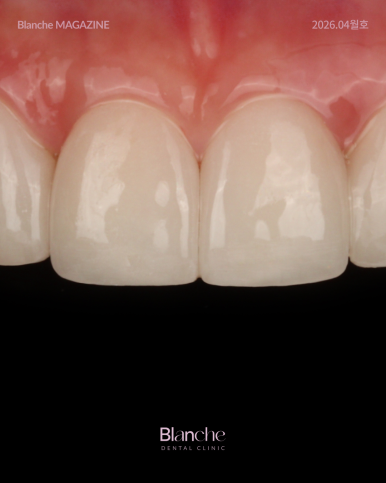 무삭제 라미네이트? 누구나 할 수 없는 진짜 이유 관련 이미지 9