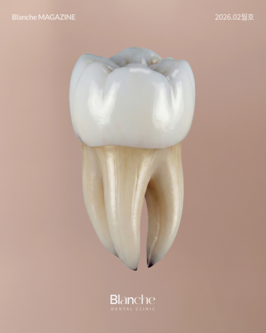 충치 치료, 무조건 깎아서 씌워야 할까? 관련 이미지 3