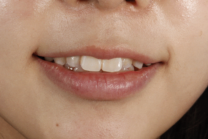 무삭제 라미네이트 부작용, 모르고 진행하면 손해보는 이유 관련 이미지 4