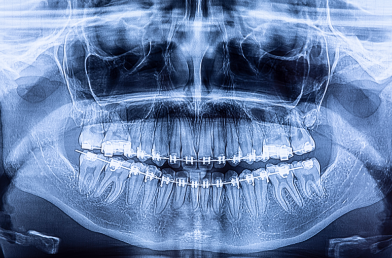 The Real Cause of Canker Sores You May Not Know: A Gangnam Dentist Explains How to Heal Canker Sores Fast image 6