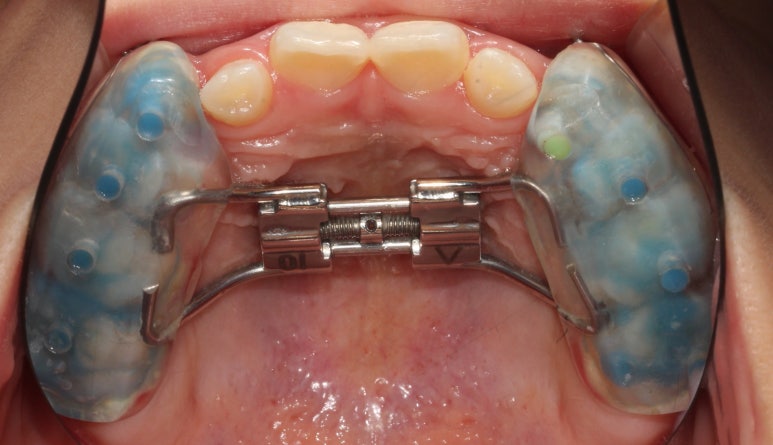 덧니 교정 비용? 관련 이미지 5