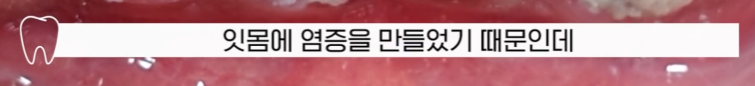 (피나는)잇몸 스케일링 방치하면 위험한 이유 관련 이미지 10
