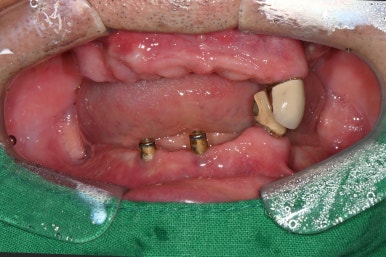 임플란트가 두렵다면 반드시 읽으세요! 관련 이미지 7