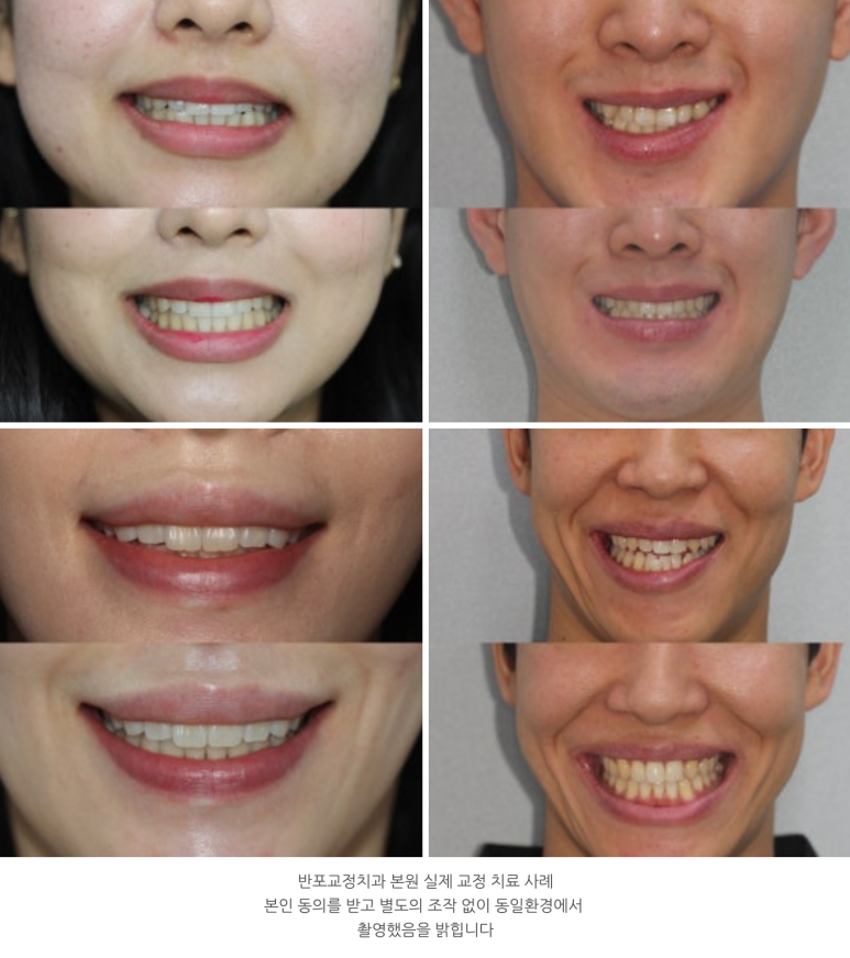 반포치과 앞니 부분교정 고려중이라면 필독 관련 이미지 5