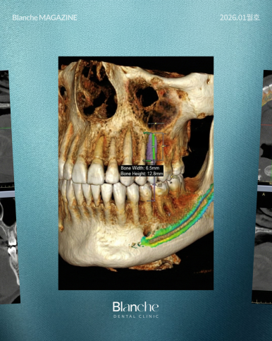"임플란트 뼈이식, 무조건 해야 하나요?" 과잉진료 피하는 법 관련 이미지 9