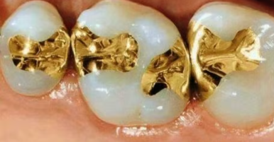 충치치료 비용 건강보험 적용 기준은 관련 이미지 5