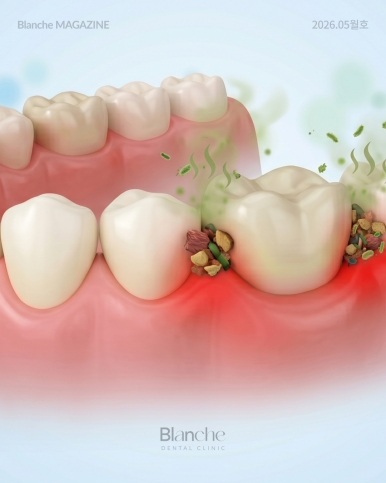 Black Gaps Between Teeth After Orthodontic Treatment image 12