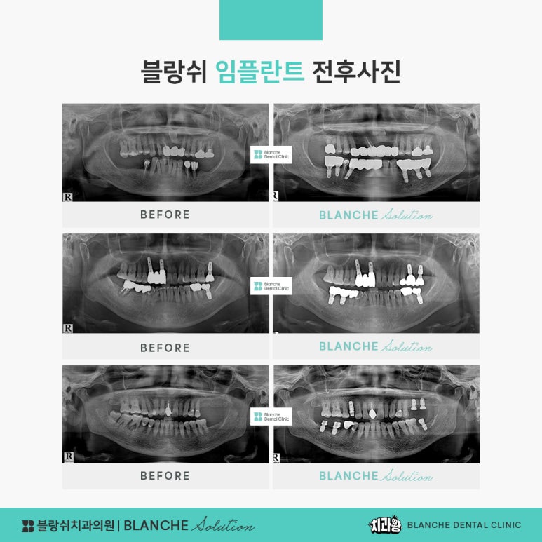 수면임플란트센터, 프리미엄 임플란트 진료는 블랑쉬치과(Blanche Dental Clinic) 관련 이미지 27