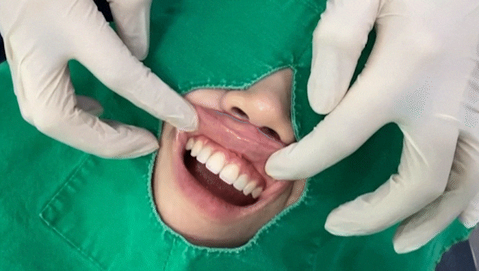 라미네이트 통증 걱정된다면? 가수면으로 편안하게 받으세요 관련 이미지 5