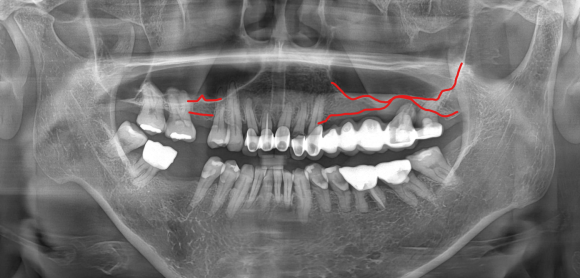 신논현치과 임플란트 뼈이식 강남 치과의사로서 솔직히 말씀드립니다. 관련 이미지 7
