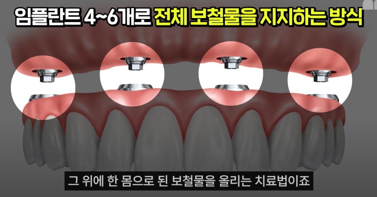 풀아치 임플란트 치과? 임플란트 결정 전 꼭 읽어보세요. 관련 이미지 4