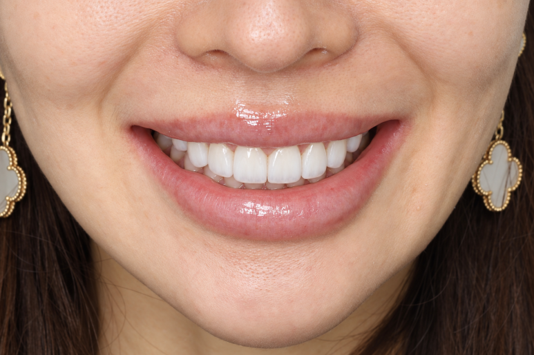 Same-Day Veneers in Korea : Cost, Process & Tips - Blanche Dental Clinic 관련 이미지 7