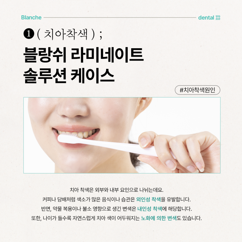 블랑쉬 라미네이트 솔루션 사례 (치아착색개선) 관련 이미지 2