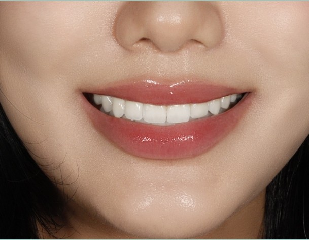 앞니라미네이트 부작용, 어떤 문제들이 생길 수 있을까요? 관련 이미지 1