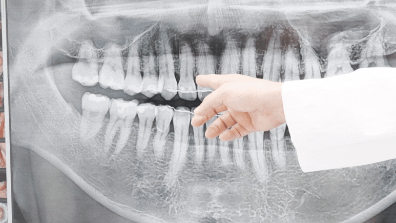 엠도게인, 논현역 치과에서 잇몸 살리는 방법을 말씀드립니다 관련 이미지 4