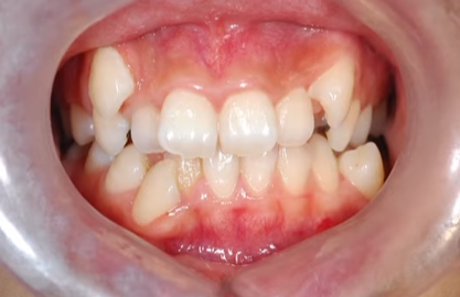 뻐드렁니 교정 2년 고생하고 후회하는 사람 vs 6개월 만에 인생 미소 찾은 사람 관련 이미지 2
