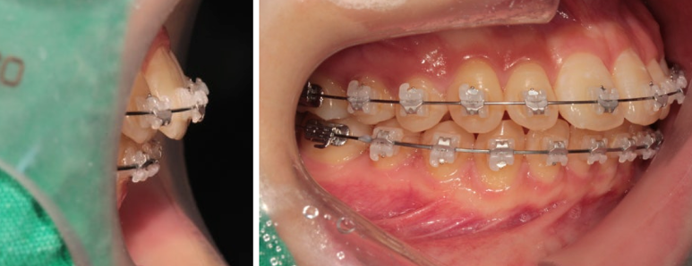 강남 돌출입 교정치과 분납 비용 부담된다면 관련 이미지 3