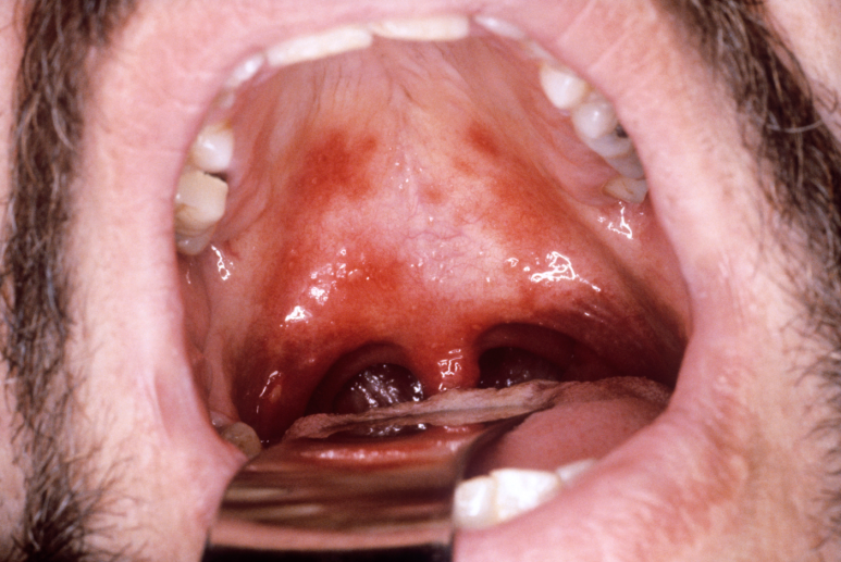 The Real Cause of Canker Sores You May Not Know: A Gangnam Dentist Explains How to Heal Canker Sores Fast image 4