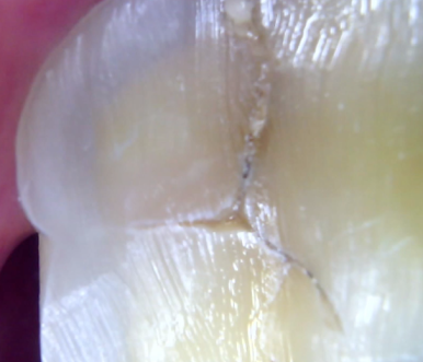 이빨 깨짐 방치하면 발치까지? 크랙치아 치료법과 응급처치 관련 이미지 4